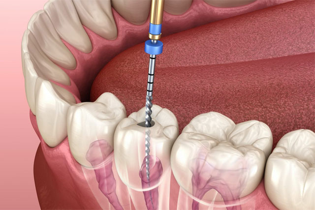 Root Canal