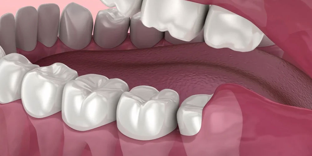 Wisdom Tooth Extraction Procedure