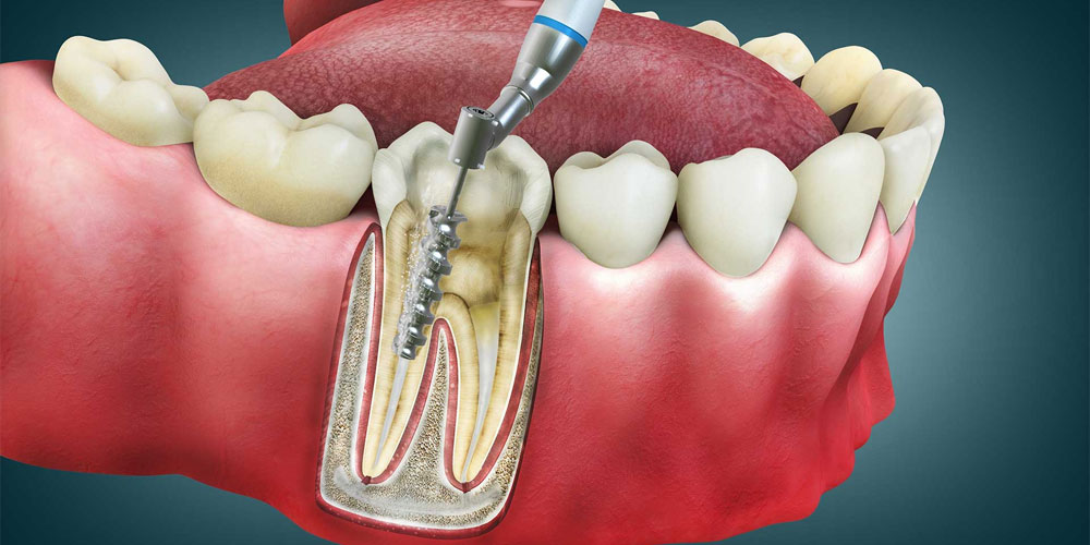 Root Canal Before and After