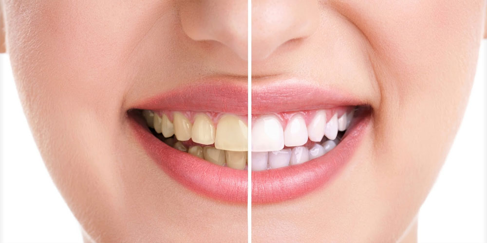 Before and After Teeth Whitening